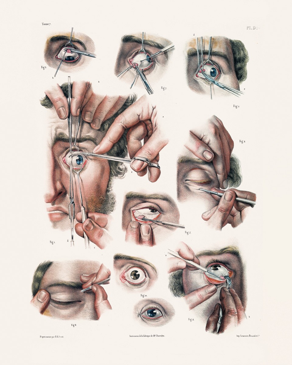 Chirurgie des Augenmuskels (Strabismus) | Tome 7. Planche D. Surgery of the muscles of the eye. | Copyright: TASCHEN